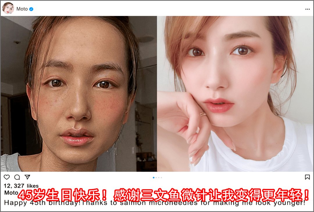 最新除皱科技,最新除皱科技，重塑青春的神奇力量