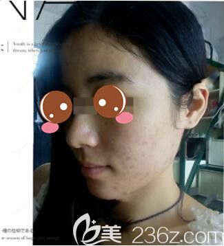 E光祛痘价格揭秘，背后的力量与自信绽放的旅程
